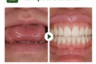 Complete Dentures