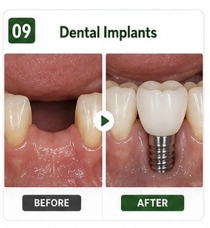 Dental Implants