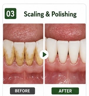Scaling and Polishing