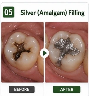 Silver (Amalgam) Filling